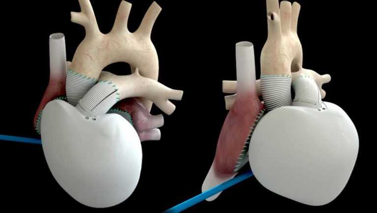 Jornal Campeão: Saúde: Implantado primeiro coração artificial em Portugal