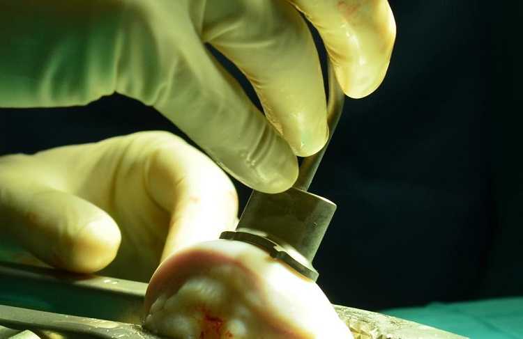 Jornal Campeão: CHUC realiza segundo alotransplante osteocartilagíneo maciço fresco